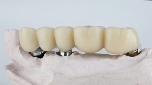 dental implants in jawbone