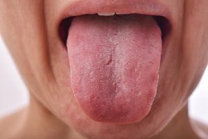 tongue signs about dental health