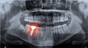 dental implant emergency